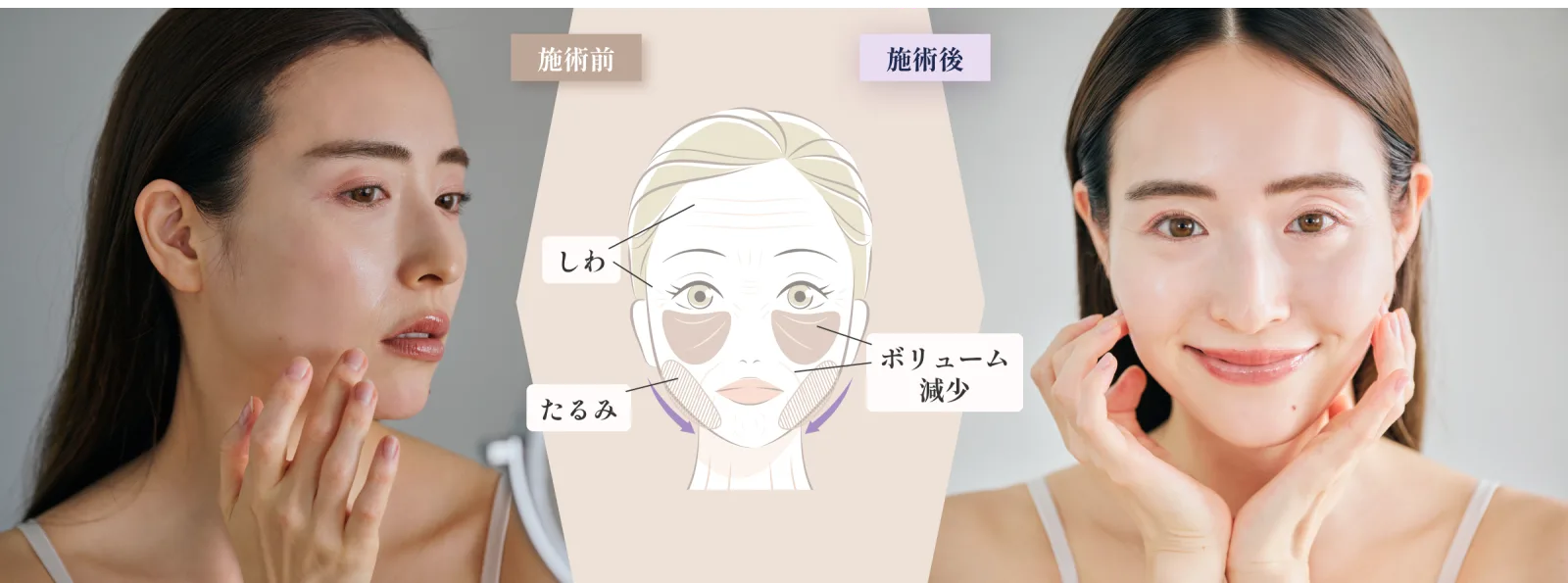 施術前と施術後の比較イメージ