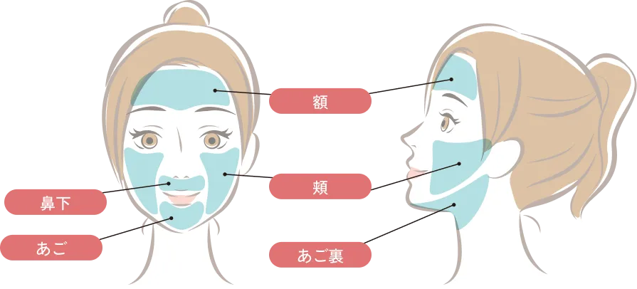顔脱毛の施術部位イラスト（額・頬・鼻下・あご・あご裏）