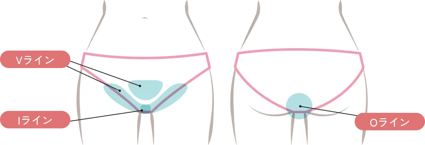 VIO脱毛の施術部位イラスト（Vライン・Iライン・Oライン）