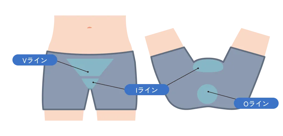 VIO脱毛の施術部位イラスト（Vライン・Iライン・Oライン）