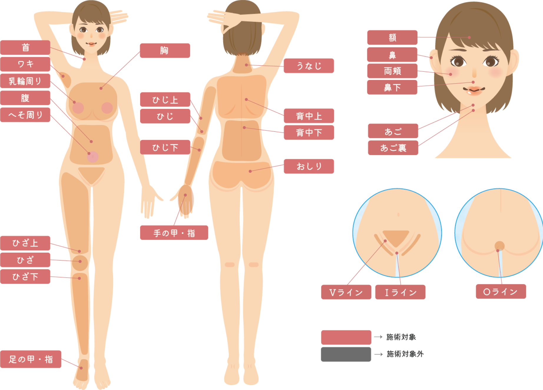 全身脱毛パーフェクトコースの治療対応各部位の図解