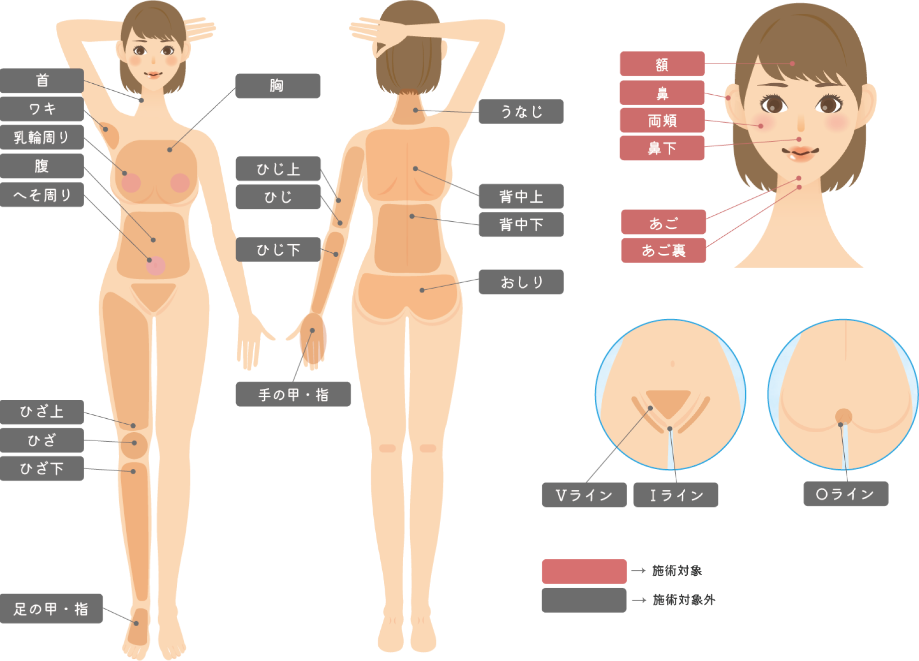 脱毛の顔全体の治療対応各部位の図解