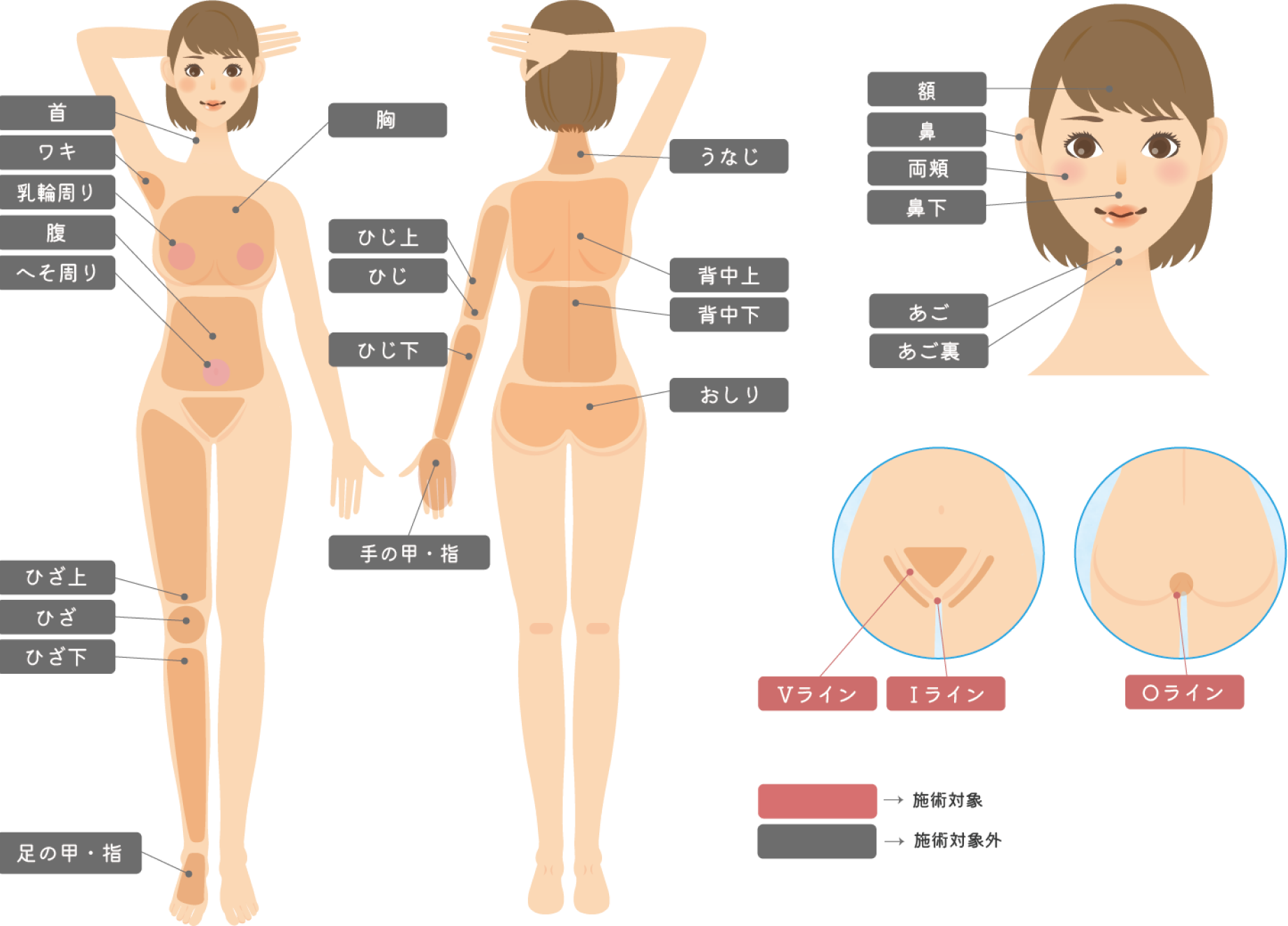 脱毛のVIOの治療対応各部位の図解