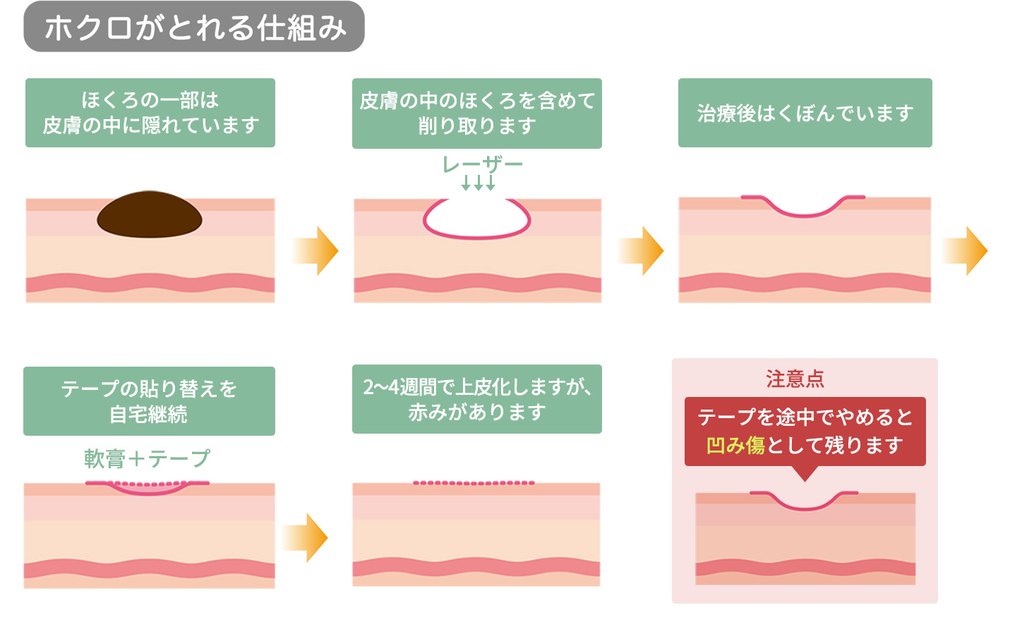 東京都中野区・JR中野駅徒歩1分の皮膚科・美容皮膚科、中野駅前クリニックのほくろが取れる仕組み