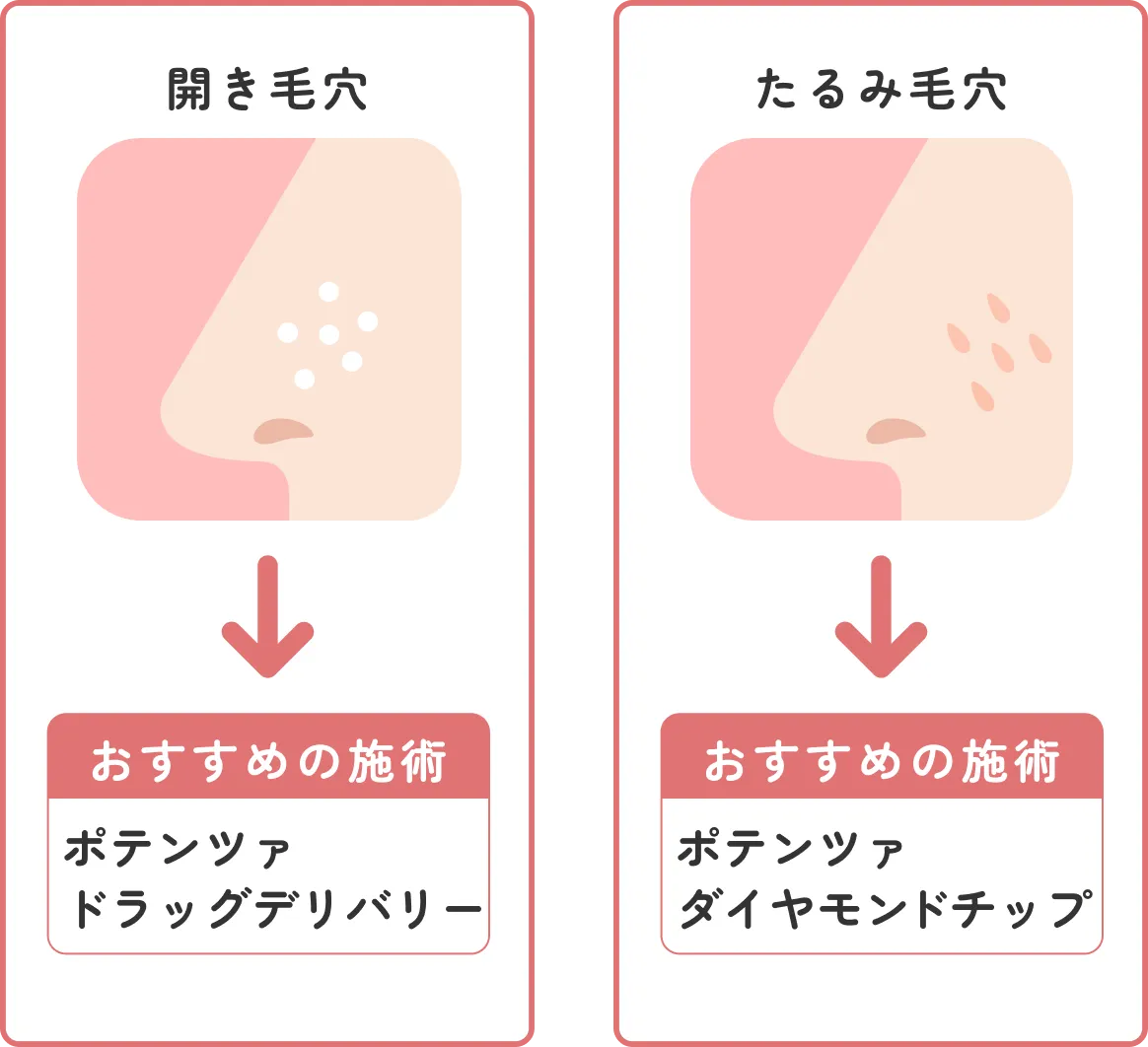 開き毛穴・たるみ毛穴のおすすめ施術